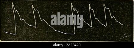 . Les maladies du coeur et l'aorte thoracique. Piessiire 3 oz.Fig. 275.-axillaire gauche d'anévrisme Arte7-y (traciiig radial gauche).-L. G., set.63, admis à l'infirmerie de Newcastle 7 mars 1878, avec un largeaneurism de l'artère axillaire gauche. L'apex est arrondi ; tous les curvesare oblitérée.. Pression 3 oz.Fig. 276.-anévrisme de l'artère axillaire gauche (droite). radial radial droit-tracingfor le même patient. L'impulsion est intermittente, mais toutes les courbes sont wellmarked. Banque D'Images