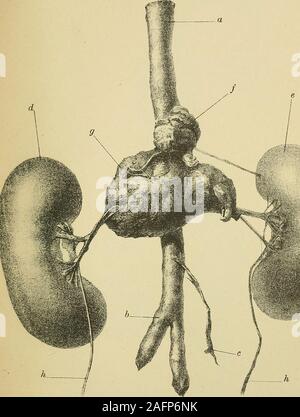 . Les maladies du coeur et l'aorte thoracique. -Posés, l'anévrisme disséquant est appelé. Une combinaison de ces différentes formes n'est pas rare rencontré (voir fig.268 et 269), dans lequel il y a trois anévrismes, l'un d'un goodexample ou de l'amas globulaire, et la variété fusiformes othertwo sacculated). Étiologie et pathologie.-Les grandes causes de l'anévrisme de l'aorte thoracique, en fait de tous les anévrismes internes, d^re, premièrement,local faiblesse de la paroi artérielle, et deuxièmement, increasedarterial la pression artérielle. La cause la plus commune des faiblesses de l'aorticwall est chronique endarteritis (athérome), Banque D'Images