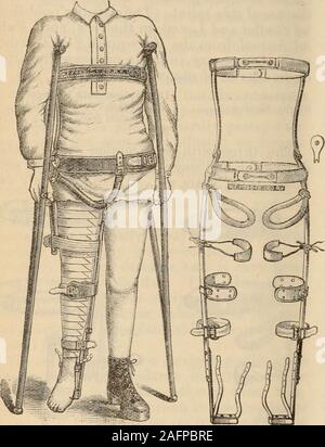 . Virginia medical semi-mensuels. Fig. 1.-Le dispensaire bon marché Fig. 2.-Bar à l'intérieur et l'LateralSplint. Tractions. cas sans raccourcissement. Le fichier .splint utilisé wasthe traction depuis longtemps, que j'ai déjà de-repères-un qui admet d'enle de la hanche, et le patient est admis il towalk npon. Cette duringa splint a été mis au point du temps où l'on croyait que wouldproduce aukylosis la fixation de l'articulation et qui motionwas nécessaires pour maintenir l'alimentation des thejoint. Il est inutile de dire que nous avons produites à l'extérieur de ces idées. Les statistiques de l'hôpital Rue ofChambers cinquante consecu lo Banque D'Images