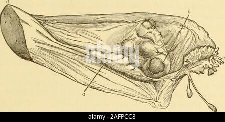 . Gyncology clinique, soins médicaux et chirurgicaux. entre le tube et l'ovaire et de l'autre sous l'ovaire.vrai varicocèle est à distinguer de la simple dilatation variqueuse des theveins pampiniform, du plexus comme connectionwith est fréquemment trouvée dans les tumeurs de l'utérus et des ovaires. Dans l'ancien il y a une dilatation permanente des vaisseaux, les parois épaissies,et elles contiennent souvent des thrombus ou phleboliths. Il isdoubtful si une comparaison peut être faite entre dans la varicocèle malignes de l'ovaire, TUBES, et vaste des ligaments. 739 Banque D'Images