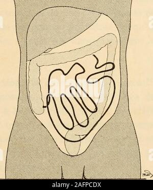 . Pot du médico-chirurgicale de l'abdomen. Fig. 34. - Disposition des anses grêles et situation. Même sujet que sur les figures 30, 31, 32. Le paquet des anses grêles a été enlevé. On voit les loges a létage de sous-tho-racique de labdomen dans lesquelles viennent se placer les anses grêles. Lecôlon droit occupant presque tout le côté droit de labdomen, les anses se grêleshorizontales logent presque en totalité à gauche, en avant du côlon descendantqui est étroit et très postérieur. Les anses verticales sont reçues entre les deuxpsoas et dans lexcavation pelvienne. XL Page 95. R. Grégoire. Planifier Banque D'Images