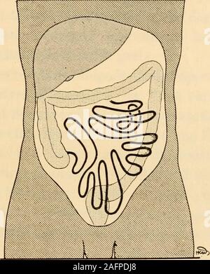 . Pot du médico-chirurgicale de l'abdomen. Fie. 30. - Disposition des anses grêles et situation. Le sujet a été durci au formol.On voit que la masse des anses grêles occupe la moitié gauche de labdomen et lepelvis. Le côlon descendant est en arrière. Le côlon droit occupe presque toute droite lamoitié de labdomen. Les anses grêles supérieur, s sont sensiblement horizontales. Les anses grêles dans-férieures se disposent verticalement. Le côlon transverse, relevé ici, se couche, chez ce sujet, entre la première etla seconde anse g-rêle horizontale. IX. La page R. Grégoire. Planche XXIV (pages 89 à Banque D'Images