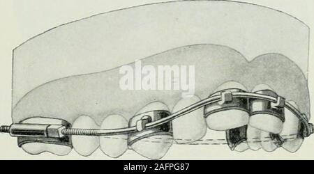 . Lehrbuch der orthodontie fur studierende und zahnartze enschluss mit der Geschichte der orthodontie. Fig. 417. Fig. 416. Weise allmählich durch die Wirkung des Drahtbogensverlängert federnde werden.. Fig. 418. Dans la Fig. 419 sehen wir ein Verfahren, die Schneidezähne Banque D'Images