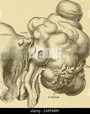 . Gyncology clinique, soins médicaux et chirurgicaux. dans le cadre d'epithe-lioma de l'utérus, un fait qui a été constaté par ceux qui ont de l'expérience hadmuch avec disparition totale-est sans doute en raison de l'peculiardistribution de les lymphatiques à la base des ligaments larges, theirconnection avec l'ovaire étant moins intime que ceux dans le upperborders. L'infection lymphatique est également observée dans l'abcès de l'ovaire suivez-ing d'endométrite puerpérale, fosse septique. Les dépôts métastatiques ont été observées dans l'ovaire en cancer de thebreast, et moins souvent en maladie primaire d'autres viscères, en particulier e Banque D'Images