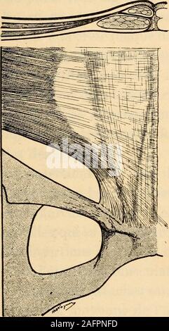 . Pot du médico-chirurgicale de l'abdomen. Fi&Lt ; ;. 7. - Le muscle petit oblique de labdomen (daprès Poirier) IV. Paçe 24. R. Grégoire. Planche VIII (pages 24-25],. Fig. 8. - Les médecins se fixe desfibers delarcade nées oblique du petit crurale. Les fibres supé-rieures contribuent à lagaine pyramidale du ancien. L es fibres in férieures-letendon contribuent à l'ancien conjoint. L e schéma situé en haut de lafigure montre une coupe de laparoi abdominale faite au-dessusdu pubis. 1 e petit et letransverse oblique forment la gaine dumuscle, pyramidale en arrière dutendon aponévrotique du grandobli Banque D'Images