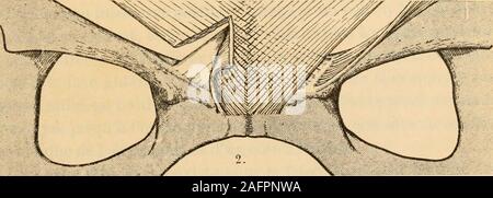 . Pot du médico-chirurgicale de l'abdomen. Fig. 6. - Le grand muscle oblique de labdomen.. I. Le grand muscle de labdomen oblique (daprès Poirier).- 2. Remarquer lemode dattache du muscle au niveau de la surface pubienne. III. Pase 22. LA PAROI antéro-latérale 23 sont pour la plupart la continuation tendineuse du faisceau charnuné de la huitième côte. Après quelques centimètres de trajet, ellesse divisent en deux faisceaux qui sécartent de plus en plus lunde lautre. Le faisceau externe se porte en dedans et un peu en fibres ses bar,dans la première partie de leur trajet, se superposent dans Banque D'Images