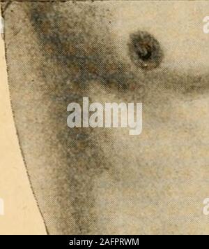 . Pot du médico-chirurgicale de l'abdomen. anormal de la cavité du ventre. Il réponden arrière au bord supérieur de la IVe maître juré lombaire. Chez lhomme adulte et jeune, lombilic siège un peu au-dessousdu milieu de la ligne qui unit la base de lappendice xyphoïde aubord supérieur de la symphyse pubienne. Il not appear quela forme du thorax ou celle de labdomen influent sur cette situation. Après un grand nombre de faitestant mensurations que nous avons sur le cadavre que sur le vivant, nous sommes arrivé au résultatsuivant. La ligne xypho-pubienne mesure en moyenne, sur deshommes de 1 m Banque D'Images