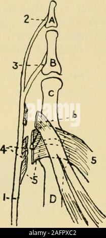 . Manuel de chirurgie opératoire. tion d'hyper-extension tandis que les deux distalphalanges devenir en flexion. La déformation est bien sûr la plus marquée dans la bagueet le majeur. Si la lésion au nerf ulnaire est très haut, puis le innerhalf du flexor digitorum profundus est aussi impliqué et pas de griffer de thefingers est produite. Les tendons extenseurs des doigts du col du poignet au-dessus de la Tête du métacarpien os, et chacun envoie un bordereau d'insertion pour les bases de la première, deuxième et troisième phalanges respectivement. Au niveau de l'metacarpo--phalangienne, une expansion fibreuse passe fr Banque D'Images