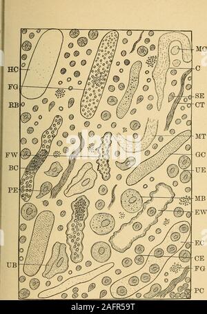 . L'analyse urinaire et le diagnostic par examen microscopique et chimique. lieu ; ces cas sont décrits comme pyonephrosis. Causes.-Les causes d'une néphrite suppurative ne sont pas toujours plain,bien que dans de nombreux cas, la maladie est le résultat d'une extension de l'en-flammatory de certains processus d'autres partie du tractus génito-urinaire.Un simple la gonorrhée, qui s'étend progressivement vers le haut, peut être sufficientto la provoquent, et les sténoses de l'urètre, et l'inflammation et l'hypertro-phy de la prostate peuvent être causes. L'utilisation de sons impurs et 1cathéters, même en ces jours d'antisepsie, est Banque D'Images