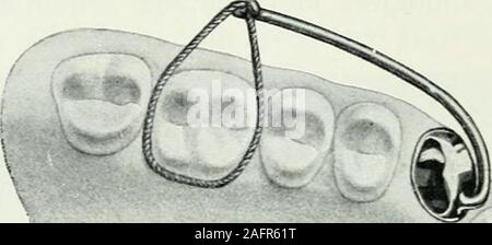 . Lehrbuch der orthodontie fur studierende und zahnartze enschluss mit der Geschichte der orthodontie. Fig. 323. Fig. 324 illustriert sein Drehungsverfahren. Der zu drehendeZahn Goldkappe erhält eine, an die ein im rechten Winkel- ge. Fig. 324.bogener Drahthebel angelötet ist, dessen freies Ende dans einenKnopf ausläuft, der zur Befestigung mit Ligatur dient, womit Banque D'Images