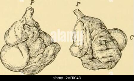 . Gyncology clinique, soins médicaux et chirurgicaux. ng-bas isfrequently personnage présent. Ils peuvent aussi être une cause de stérilité. Les tumeurs Myxomatous sans complications avec d'autres tissus sont ex-ceptional. La complication la plus fréquente est la présence de faisceaux de fibres musculaires lisses dans le trabecularof myxomatous le tissu, le calledmyo myxomata--. Plus frequentlywe encore rencontrer une complication de glandu-lar, habituellement des tissus du type tubulaire cilié épithélium columnaire.thelining composent de ces glandes tubulaires. Thesetumors sont plus fréquentes dans les cervi-cal canal. L'ajout de la glandul Banque D'Images