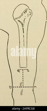 . Manuel de chirurgie opératoire. Fig. 1442.-cinématographique d'amputation. Fig. 1443.-(L'Ashhiirst Annales Med.) et l'index pourrait être fléchi par le tendon boucle pour laquelle ils wereconnected par un crochet métallique. Le patient a été en mesure de saisir et retenir. variousobjects ii68 AMPUTATION OU DÉSARTICULATION dans la description ci-dessus, les tendons fléchisseurs de la société profundus ne sont pas divisé, mais probablement leur division en dessous de leur union avec le flexor sublimis wouldgive une plus grande mobilité. Ashhurst (Annales Surg., déc., 1914) opère sur thearm comme suit : l'Étape I.-reflètent un lambeau cutané longitudinal aussi longtemps que la d Banque D'Images