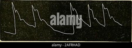 . Les maladies du coeur et l'aorte thoracique. Pression 3 oz.Fig. 129.-Aneuristn à gauche de l'artère axillaire (traces) radial gauche.-L. G., set.63, admis à l'infirmerie de Newcastle 7 mars 1878, avec un largeaneurism axill de l'artère gauche IRI. L'apex est arrondi ; tout le curvesare oblitérée.. Pression 3 oz.Fig. 130.-anévrisme de l'artère axillaire gauche (droite). radial radial droit-tracingfor le même patient. L'impulsion est intermittente, mais toutes les courbes sont wellmarked. Banque D'Images