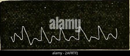 . Les maladies du coeur et l'aorte thoracique. ecome énorme, en raison de l'greatmomentum du fluide, comme cela a été montré par Marey. Le liquide restant le même, l'oscillation sera plus amplement plus la vitesse initiale, et le moreslowly que la vélocité est cochée. Ce dicrotism est promu par un actionof soudain le cœur, et aussi par des artères, la distensibilité par lowness de la pression artérielle, et par la liberté d'écoulement. Je pense que dans l'examen de cette origine des dicroticwave, une attention suffisante n'a généralement pas été versée à la partie importante il playedin par l'inertie de la flui Banque D'Images