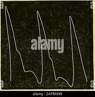 . Les maladies du coeur et l'aorte thoracique. Fig. 73.-Pression 2 os. Fig. 74.-Pression 2 oz. Fig. 73 et 74-Modifications dans le pouls-tracing comme résultat d'Ike Ex-citement cardiaque.-A. M., la formation des adultes. 48, admis à l'infirmerie de Newcastle sufferingfrom la moelle obscurs symptômes. Le cœur est devenu excité et la tracingshown dans fig. 74 a été prise immédiatement après celui de la fig. 73, theinstrument entre-temps restant en place. La pression du ressort de wasthe même dans chaque cas. Banque D'Images