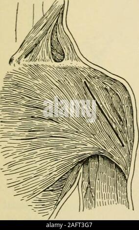 . Manuel de chirurgie opératoire. vers l'inser-tion du deltoïde (Fig. 1340). L'incision de la peau et divise le subcutaneoustissues. La distinction entre la partie antérieure ou interne (pectoro-groove deltoïde) border du deltoïde. Inciser le muscle deltoïde légèrement vers l'extérieur de, et parallèle à sa marge nal, évitant ainsi un dommage à la veine céphalique et une grande branche de l'artère thoracique-theacromio. La rétraction du côté extérieur de la plaie et de la peau (del-toid), exposant ainsi la tête de l'humérus. L'étape 2.-tourner les bras de manière à faire la rainure bicipital. Inciser la capsule qui thejoint tout au long de son Banque D'Images