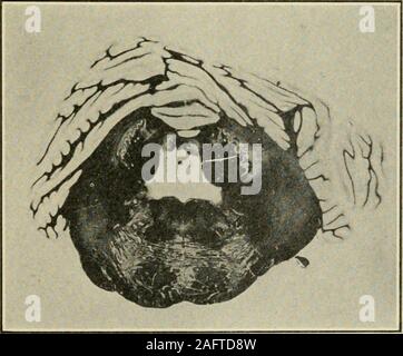 . Le Journal of Nervous and Mental Disease. Fig. 8. Section à travers l'extrémité antérieure du droit corpus den-tatum et le niveau du trijumeau pons. L'asymétrie particulière de l'hemi-spheral lobules. ensemble. Le corps olivaires accessoires, les noyaux de l'lateralcolumns, les noyaux arqué et l'abord antéro-externe et postéro-externe fibre arquée de systèmes, ainsi que les noyaux de l'posteriorcolumns sont tous parfaitement normale. À la marge latérale de lavis de la médulle sur les deux côtés du domaine de la dorsale spino-cere-bellar digestif est moins profondément que les vitraux, la matière blanche Banque D'Images