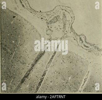 . Le Journal of Nervous and Mental Disease. Fig. 3. L'hémisphère cérébral de Pia couvrant les droits de l'affaire No 510, X 150.montrant avec une légère infiltration d'oedème pial. afifected les portions sont plutôt irrégulières. La réaction inflammatoire est généralement plus marqué sur la surface antérieure de l'cordand dans le pli de la partie antérieure de la moelle. Il est généralement plus J04 HUBERT S. HOWE grave dans les élargissements cervical et lombaire. Dans le involvedareas l'ÉFVP est épaissi et oedémateux. Ses vaisseaux sanguins et Banque D'Images