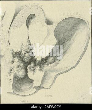 . Le diagnostic et le traitement des maladies de la femme. nant une fibromyoma la tumeur s'étend.comme elle pousse, pousse de côté les tissus adjacents, mais une malignanttumor comme elle pousse pénètre dans les tissus adjacents et les détruit. C'est cette implication de insidieux qui fabrique de nombreux tissus contigus ne fonctionne pas lorsqu'il cervicalcarcinomata vus pour la première fois. C'est cette même extension progressive vers l'extérieur 664 Maladie maligne de l'utérus par continuité de tissu qui plus tard le patient la plupart des causes de sa souffrance et qui dans la plupart des cas, les causes de sa mort, en impliquant l'utérus ou de la vessie ou du rectum. En poste à l'aide de Banque D'Images