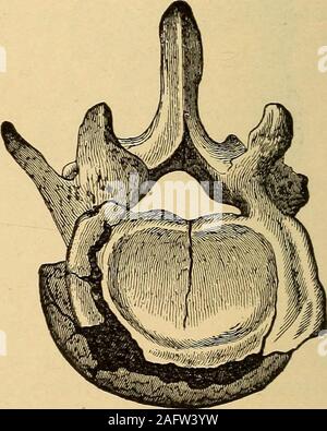 . Un traité pratique sur les fractures et luxations. La rupture avec compression de la troisième et quatrième. vertebiie lombaire ou au-dessous. Le disque intervertébral peut être partiellement évincés, apportant avec elle une échelle de l'os de l'autre ou les deux vertèbres. Fracture de l'arcs vertébraux, selon Gurlt, se retrouve dans les cas de fracture abouthalf des vertèbres cervicales, et seulement dans un septième de ceux de la dorsale, et un huitième de ceux de la région lombaire.^ ^ pour les cas de caractère douteux dans les vertèbres lombaires, voir la section sur la course et Ter-minations. Les FRACTURES DE L'VERTEBRJE. 157 Il à Banque D'Images