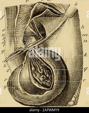 . L'anatomie et de chirurgie de hernie abdominale. § C ct. Banque D'Images