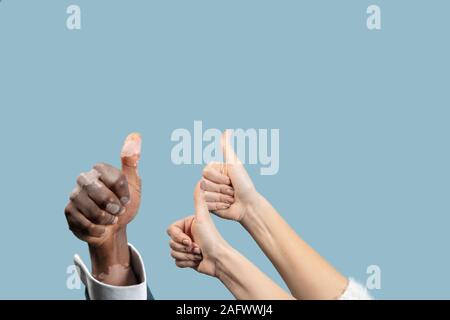 Portrait de l'homme et de la femme les mains avec pigments vitiligo isolé sur fond studio bleu. Portant une tenue de bureau. Spéciale de peau. Showing Thumbs up. Affaires, finances, ad concept. Copyspace. Banque D'Images