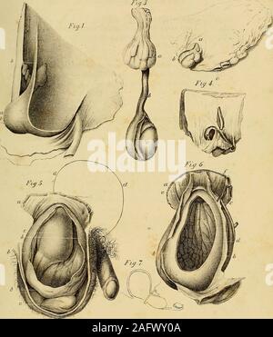 . L'anatomie et de chirurgie de hernie abdominale. ine de la vessie dans le ca-abdominale vity.e. Les testicules. 388 EXPLICATION DE LA PLAQUE XL Fig. 6. Montre Fig. 5.a disséqué plus complètement. Col de l'orifice herniaire péritonéale ou sac.b b. Sac herniaire ouvert comme dans Fig. 5. c. Ouverture de la communication entre la partie en saillie de la vessie et qu'à l'intérieur de l'abdomen ; la vessie étant dans cette vue en coupe. d. L'intérieur de la vessie exposées. e. L'artère épigastrique, en tenant le même cours que en oblique ingui- nal hernie de la politique genre./. Les abdominaux. Cochon. 7. Un schéma expliquant le Banque D'Images