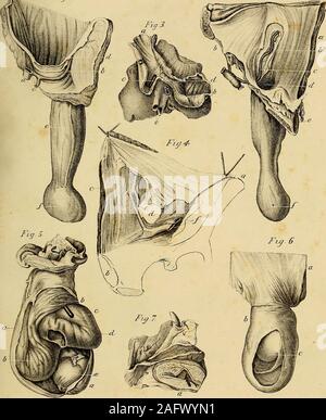 . L'anatomie et de chirurgie de hernie abdominale. 4. Représente la division de l'artère épigastrique, dans un cas d'-stran hernie inguinale oblique réglementé.-wassent La préparation à moi par M. Lawrence. a. Colonne vertébrale de l'iliumv b. Pubis. c. Muscle Rectus. d. Embouchure de la sac herniaire. e. Extrémités de l'artère épigastrique divisé.f. Vaisseaux fémoraux.-Voir les causes. 49386 PLAQUE D'EXPLICATION X. Fig. 5. Intestin expositions par l'épiploon étranglée.a a. Sac herniaire congénitale coupés.b b. L'épiploon collée au fond du sac. c. Bougie est passé sous la bande de constriction de l'épiploon. d. Inte Banque D'Images