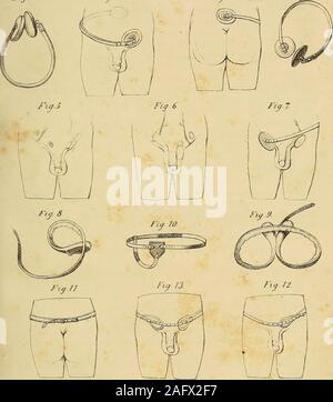 . L'anatomie et de chirurgie de hernie abdominale. e partie inférieure de la colonne vertébrale est illustré. Dans ce nocircular ou sangle de cuisse de treillis sont nécessaires. Fig. 4. Le saumon et de treillis Odys dépouillé de son enveloppe pour montrer son appareil, et socket balland la ruse par qui ensembleressort peut être allongée ou raccourcie à plaisir. Fig. 5. Représente les deux ouvertures par lesquelles une herniadescends oblique, et la situation de l'artère épigastrique ; ligament belowPouparts sur le côté gauche, est souligné le rôle d'un onwhich truss devrait être appliqué pour une hernie fémorale. Fig. 6. Hernie oblique passant e Banque D'Images