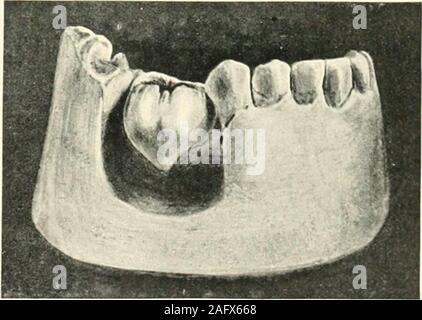 . La science et la pratique de la chirurgie dentaire. ly en liaison directe avec l'enamelof ^la cro, mais ils sont très rares. L'Onsection jjrojecting normaldentine des nodules de la de la dent semble se composer d'un ofdentme de base, qui, si grande, peut contenir une prolonga-tion de pâte.^ Le plus souvent un groupe ofirregular espaces est présent dans l'neighborhoodof le nodule. Le bouchon de l'émail est bien marquée, bien que sa structure est généralement granulaire. Lorsqu'un nodule est examiné à la section de l'émail, la structure donne à penser qu'il a été produit par la dent-germe qui hasformed la trop Banque D'Images