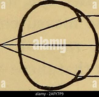 . Bonne et mauvaise vue : et l'exercice et la préservation de la vision. Fig. 25. L'ancien dépend de la planéité des theeyeball d'avant en arrière, et s'appelle télévision-eye, ou Fig. 24.. hypermétropie ; celui-ci dépend de l'allongement du globe oculaire de l'avant à l'arrière, et est l'occasion de la Fig. 25. Banque D'Images