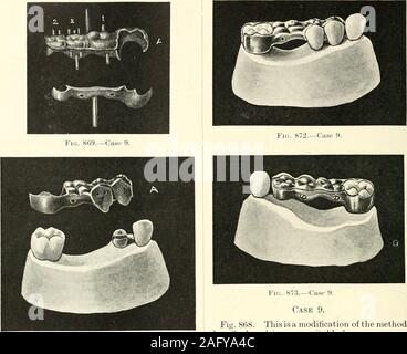 . La science et la pratique de la chirurgie dentaire. S(i8.-Ca 638. Fig. S70. Cas 9. Banque D'Images