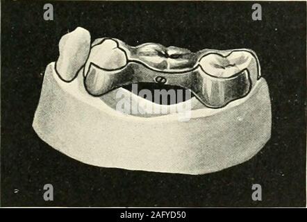 . La science et la pratique de la chirurgie dentaire. Fic ;. 857 -cas 5. Fig. S55. Cas 4.. Banque D'Images