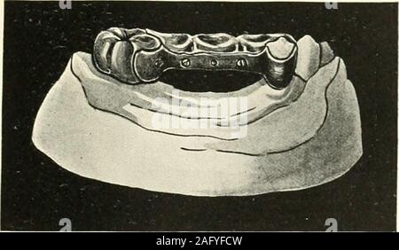 . La science et la pratique de la chirurgie dentaire. Vir.. 840.-Cas 2.. Fig. 850.-Le Cas 2. Banque D'Images