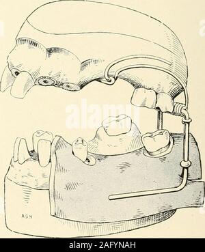 . La science et la pratique de la chirurgie dentaire. y roughenedDonaldson, enveloppés avec du coton-laine, pour thesole aiDplying objet de ciment à l'insideof les canaux, et une dalle en porcelaine blanche withineasy atteindre de la main droite, et le bas de la table fixe sur lequel il repose. Sur ce lieu thefluid et poudre de portions de la côté sideby de ciment dans deux patchs, et un peu d'hydro-naphtol ; aussi l'aide d'une poignée pour teethor avant une bascule de buis pour les dents en arrière. Afterdrying, frottez la racine-face et l'intérieur de canaux, et aussi le poste de l'crownand l'intérieur de l'embout ou base de la couronne,wit Banque D'Images