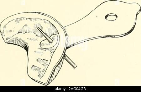 . La science et la pratique de la chirurgie dentaire. Fig. 668.-Lennoxs tenue pour impressions. (Mm. Claudius Ash, fils &Lt ;& : Co., Ltd.), donc soit la cheville doit dans certains waybe capable de dépose d'abord, ou partie d'theimpression doit être capable de dépose withoutthe goujon. Fig. 670.-home-made simple bac pour frontteeth la Couronne, faite par moulage dans une boîte de sable comme un formulaire, puis se pencher sur les côtés comme 6 platine à une ire. inclinaison correcte pour monter le taperroot-trou. Remplir le bac (Fig. 667 (1)) avec l'im-pression de la composition, et appuyez sur le fil, E,au travers de la terre. Réchauffer la sur-face de la compositio Banque D'Images