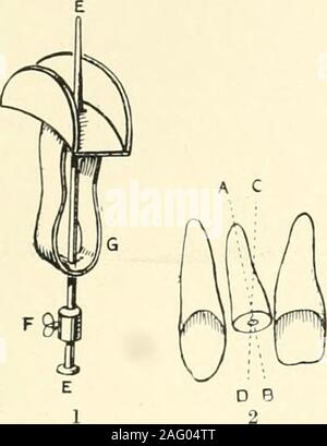 . La science et la pratique de la chirurgie dentaire. t souvent plus parfaitement que thecase serait si elle était faite à la bouche. Le reasonfor cette différence est qu'alors qu'il est impossibleto obtaiiung s'assurer d'une parfaite representationof les côtés d'une racine-fin, à moins qu'il est beaucoup fraises coniques,il est tout à fait possible qu'une règle pour obtenir une excellentimpression d'une racine-face. Pour toutes les méthodes d'un crovn ofmaking à un modèle, sauf que ofpressure-casting, une surface durable de modèle est nécessaire, comme l'amalgame, fusiblemetal ou Harvard, ciment, va donner. Donc, l'impression doit être faite avec somemateri Banque D'Images