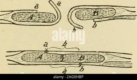 . Manuel de chirurgie opératoire. FiG. 765.-WuUsteins. Hernie ventrale pour tentes comme décrit à l'étape 3 de l'opération classique (page 617). Retirer la graisse et theskin compris entre la première incision. Terminer l'opération par la méthode Mayo. Eventration congénitale ou de l'éviscération est une difformité fatale. Thedifficulty en remplaçant les viscères est dû au fait que le infantilepot habituel est absent, le ventre muscles recti passent directement vers le bas du rebord costal à topubis ; les intestins, si distendu par le méconium, n'ayant pas pushedthem avant dans la manière habituelle. Charle Banque D'Images