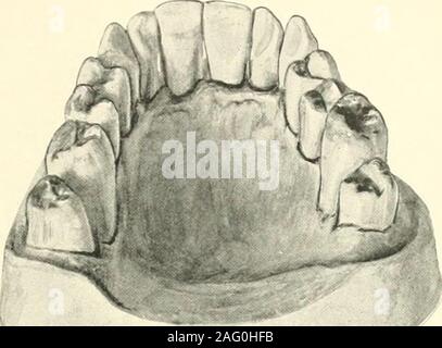 . La science et la pratique de la chirurgie dentaire. Fig. 503.-Adsanced le stade de la maladie montrant ab-sorption de sockets, l'espacement des dents, heavycalcareoiis pericemental abscessover les dépôts, et de l'incisive latérale gauche. cou des dents devient encombré andreadily saigne. Les dents sont embrassé byrings du calcul et sont légèrement desserrées(.voir Fig. 562). Plus tard, à la gomme est mark-edly congestionné, il y a une depositsof disque brun-verdâtre calcul infinitésimal autour du cou des dents, à partir de laquelle le processus d'andalveolar gomme ont reculé, souvent à l'ex-tente de révéler la bifurcation o Banque D'Images