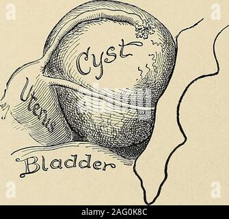 . Le diagnostic et le traitement des maladies des femmes. Fig. .387. Droit d'un hématome du ligament large.Gynecologij pratique.) (Montgomery- 3. Dans thepelvis faible venant Hydrosalpinx. La masse kystique fonctionne jusqu'en thetubal région. C'est un peu en forme de saucisse et elongatedand s'étend de l'angle supérieur de l'utérus à l'pelvicwall. Elle fluctue librement et theimpression donne d'un kyste à paroi mince. Par conséquent, certains d'une induration de l'exsudat, oradhesions peut se faire sentir. Il n'est pas tenderordinarily. C'est un peu,mobiliers mais pas autant que d'un petit pedicu tumeur ovarienne pertinent. Il est attaché à l'uter Banque D'Images