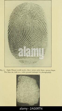 . Guide pour l'identification d'empreintes digitales [ressource électronique]. b. c. Fig. I. Les crêtes et sillons de la peau (agrandie). De nombreux endroits au lieu ot étant disposées en lignes parallèles (generallysomewhat courbes) que dans une ferme bien ordonné on peut les voir turninto une boucle ou un cercle, donnant une nouvelle orientation aux pays voisins d'ridgesand sillons et formant ainsi des modèles de grande spécificité. andsignificance Même les plus réguliers, les crêtes sont vus à split ou inscrivez-vous,comme un plan de chemin de fer, comme en fig. 2. Ces modèles sont souvent freak-like, butagain, de préserver la figure d'un champ labouré, ils regardent souvent comme si le Banque D'Images