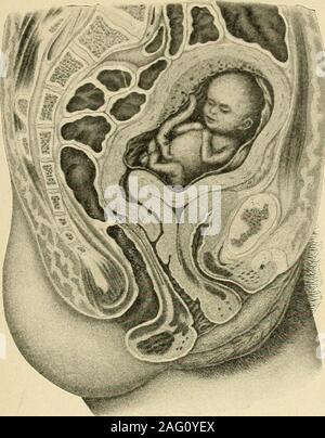 . Le diagnostic et le traitement des maladies des femmes. Fig. 363. La grossesse, environ 4 mois.(Edgar-pratique, de l'obstétrique.) L'ÉLARGISSEMENT DE LA GROSSESSE AVANCÉE 249. Banque D'Images