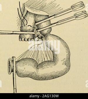 . Manuel de chirurgie opératoire. Fig. 720.-l'examen de l'intestin de constriction. (Veau). Fig. 721.-gangrenousgut Excision. faite, le plus proche des colliers le corps doit être protégé avec tubes en caoutchouc etdoit pas écraser. Si une anastomose latérale est envisagée, à l'écrasement des forceps. arebest Fossé entre les pinces, fig. 721. Ligaturer et diviser le mésentère.Déposer le tube digestif et excisés méso. 594 Avec hernie par-et-à travers le catgut sutures, fermer les extrémités des deux segmentsof qui dépasse de l'intestin les colliers. Insérer un sac-string (Fig. 721) sur le côté du corps de chaque collier. Retirez les colliers. Invaginent Banque D'Images
