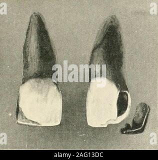 . La science et la pratique de la chirurgie dentaire. Fig. 50.1. fond arrondi de l'étape, sont mauvais featuresin la cavité dans la Fig. 495. Une étape doit, comme dans les angles havedefinite fig. 496 et 497, à l'abaissement par Conservation de l'action clé plus parfaite 429 ciment, et pour prévenir toute tendance d'theinlay à se déplacer sous l'effort. Fig. 500 montre une bonne forme de préparation de la cavité-tion pour les prémolaires inférieures. Dans la restauration de l'ensemble des parties de surfaceincluding occlusale des murs latéraux, comme dans Fig. Noshoulders 503, devrait être préparé, ou jointsupon aboutement l'émail ; l'or devrait overlapprejjared afin de clore l'émail Banque D'Images