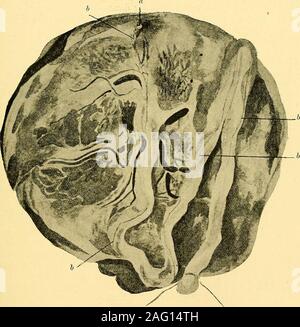 . Manuel de pathologie prénatale et de l'hygiène : le fœtus. foetus ; normalement, toutefois, la nutrition vitelline est de courte durée, d'être limité par la fin de la période d'neofoetal, ou très peu de temps par la suite. Avec certaines formes de monstruosité qu'elle peut être prolongée considérablement, et, même lorsqu'il n'existe une malformation chez le nourrisson, la persistance des andpervious les navires peuvent être retracés vitelline dans le cordon et full-timeplacenta, et ceux-ci peuvent contenir du sang. Un exemple de ces par- LA NUTRITION DU FŒTUS 155 vaisseaux vitellins inanent J'ai rencontré il y a quelques années ; le spécimen trouvé ishere (Fig. 27). Plus récemment Bover Banque D'Images