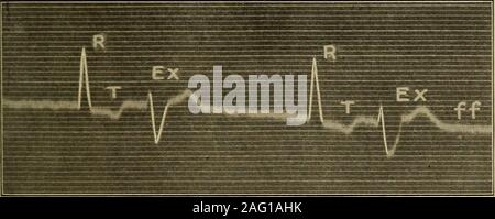 . Diagnostic médical pour l'étudiant et le praticien. Fig. 256. -Électrocardiogramme Normal inséré ici pour fins de comparaison. andcomparison. Fig. 257.-plomb I. Banque D'Images