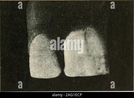 . La science et la pratique de la chirurgie dentaire. Fig. 45J. du remplissage ; tandis que le joint est coveredgingival ainsi que des caries n'aura pas lieu.L'entretien de l'spaceand proximale de la santé de l'occupant il aretherefore les tissus de première importance dans la prévention des caries et les deux pyorrhoea alveolaris.. Fig. 451. L'étudiant est conseillé de noter le^ bien organisée sous forme de lignes sur les incisives gingivale suivie dansprèsde comme ces chiffres, de sorte qu'en l'application ofligatures, instruments de finition, etc., il maythe de mieux se protéger contre la violence de la zone péri-cément, qui, si elle Banque D'Images