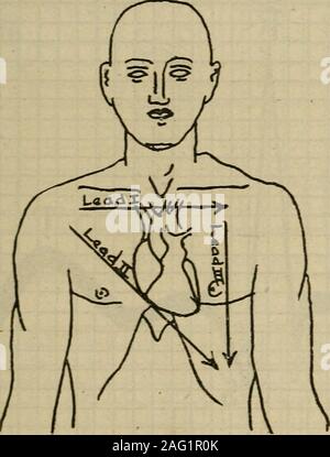 . Diagnostic médical pour l'étudiant et praticien. culière des vibrations persistent même lorsque le contact avec le patient. isabsent Le gros des ondes lentes de mouvement musculaire active sont distinctes et celles plus fines, bien que la simulation de la fibrillation auriculaire, l'absence l'absence distinctif l'onde P). Les dérivations électrocardiographiques.-l'action de l'coeur produit L'ÉLECTROCARDIOGRAMME 521 changements de potentiel électrique dans tout le corps entier et pour convenienceone ? Les extrémités pour faire les connexions nécessaires pour exploiter les courants d'action thecardiac. visiter les trois dossiers soi-disant conduit ar Banque D'Images