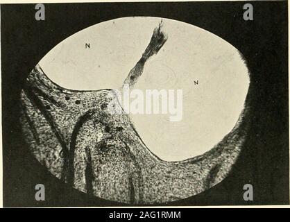 . La science et la pratique de la chirurgie dentaire. dans le acinity vesselsand le sang des systèmes nerveux. La couche basale de l'WeUand odontoblasts eux-mêmes sont l'objet d'lastto le changement. Comme il a déjà beenpointed, y kystique peut se produire indeciduous les dents. 2. Atrophie dégénérative de la pulpe.-ce 318 est semblable à la précédente, et a été pleinement démontré par soins-wedl (21) et Walkhoff(20). Le rétrécissement de l'odontoblasts est suivie,plus tard, par leur disparition totale. Le freelyanastomosing peripheralregions capillaires dans le souvent, même avant la dilatation, presentvarico Banque D'Images