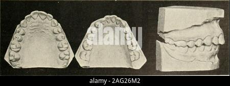 . La science et la pratique de la chirurgie dentaire. Fig. 369.-Le Cas 4. Avant le traitement.. Kio. 3jO.-Ciiso 4. Après le traitement. 242 Banque D'Images